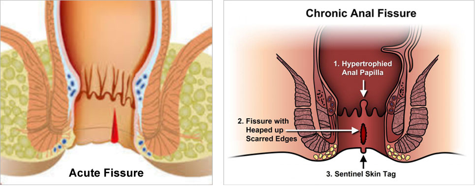 Fissure in ano